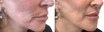 Lip Filler Before & After Gallery - Patient 300029 - Image 1
