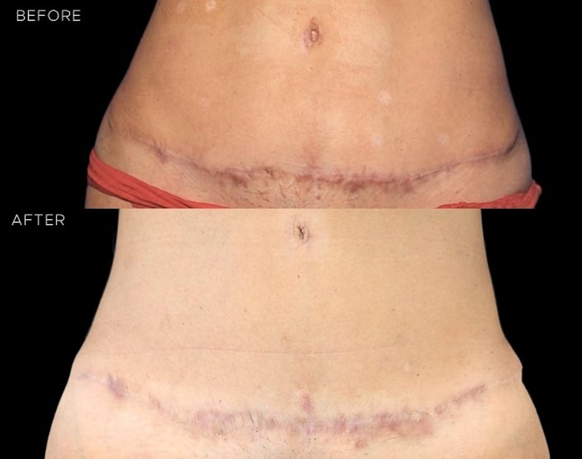 Microneedling with PRP Before & After Gallery - Patient 255819 - Image 1