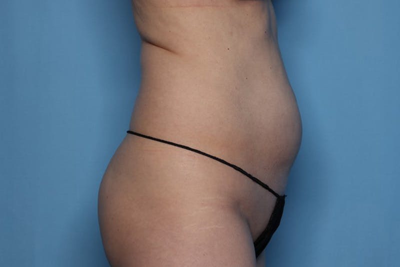 BodyTite™ Before and After Before & After Gallery - Patient 339983 - Image 3