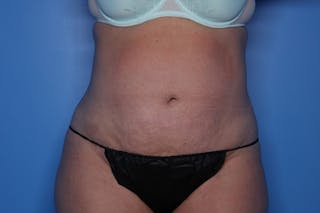 BodyTite™ Before and After Before & After Gallery - Patient 164248 - Image 2