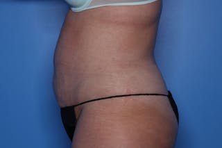 BodyTite™ Before and After Before & After Gallery - Patient 164248 - Image 6