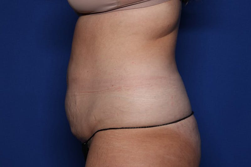 BodyTite™ Before and After Before & After Gallery - Patient 164248 - Image 5