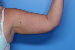 BodyTite™ Before and After Before & After Gallery - Patient 164248 - Image 12