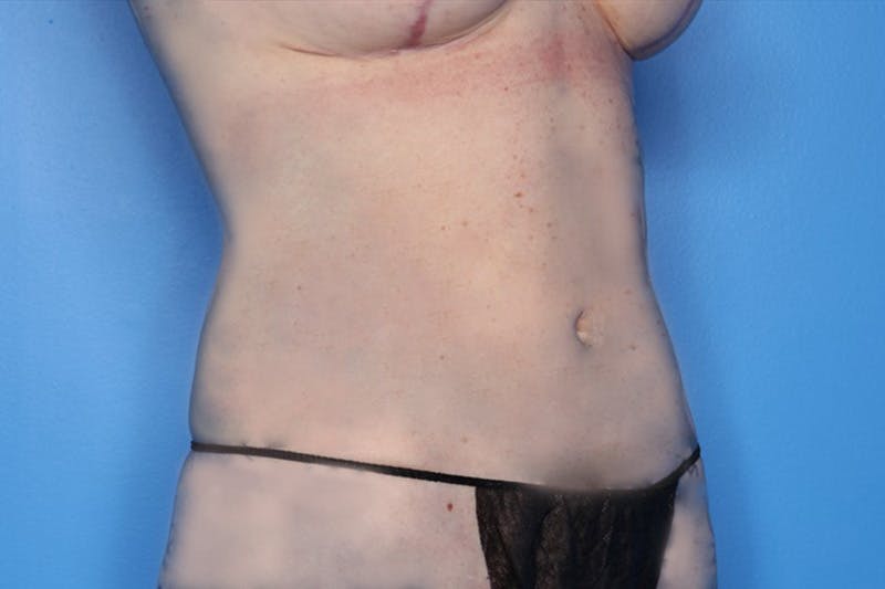 BodyTite™ Before and After Before & After Gallery - Patient 339277 - Image 2