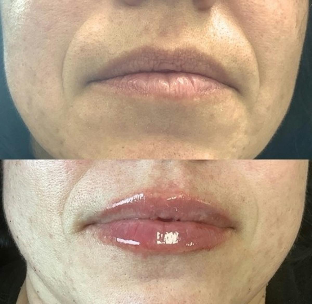 Lip Filler Before & After Gallery - Patient 467487 - Image 1