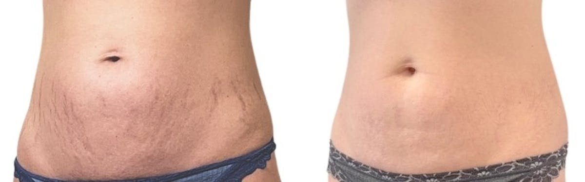 Morpheus8® Before & After Gallery - Patient 348839 - Image 3