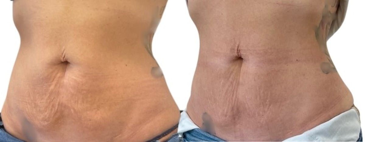 Morpheus8® Before & After Gallery - Patient 137790 - Image 2