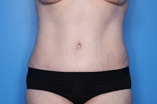 Tummy Tuck Before & After Gallery - Patient 268321 - Image 2