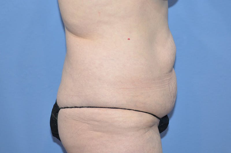 Tummy Tuck Before & After Gallery - Patient 268321 - Image 3
