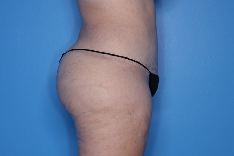 Liposuction Before & After Gallery - Patient 423232 - Image 6