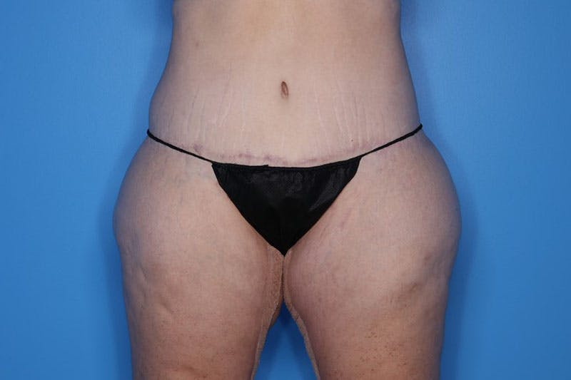 Liposuction Before & After Gallery - Patient 423232 - Image 4
