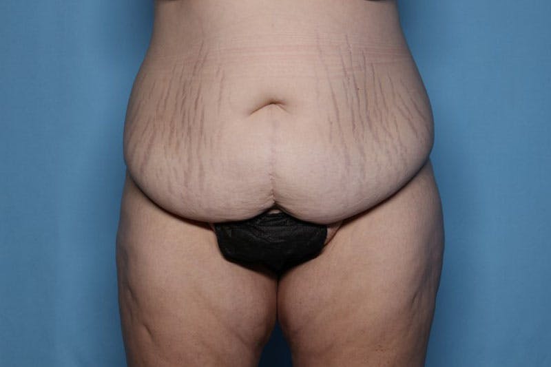 Liposuction Before & After Gallery - Patient 423232 - Image 3