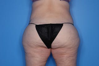 Brazilian Butt Lift Before & After Gallery - Patient 121200 - Image 4