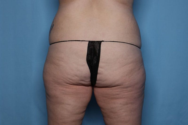 Liposuction Before & After Gallery - Patient 423232 - Image 1