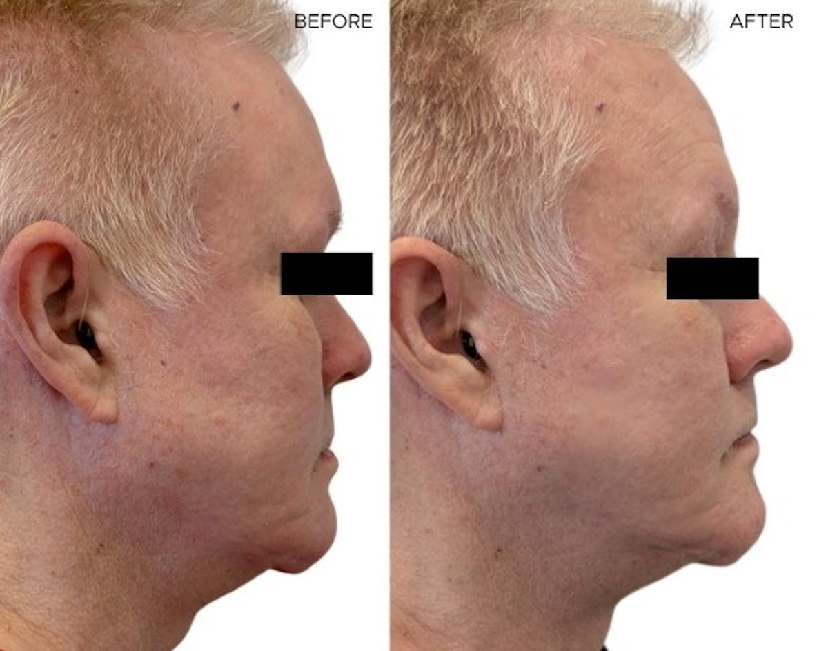 Morpheus8® Before & After Gallery - Patient 394693 - Image 1