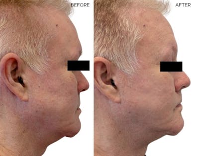 Morpheus8® Before & After Gallery - Patient 394693 - Image 1