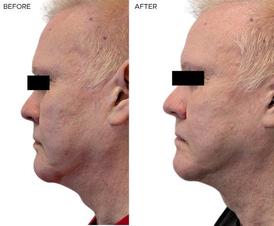 Morpheus8® Before & After Gallery - Patient 394693 - Image 2