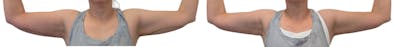 CoolSculpting® Before & After Gallery - Patient 416142 - Image 1