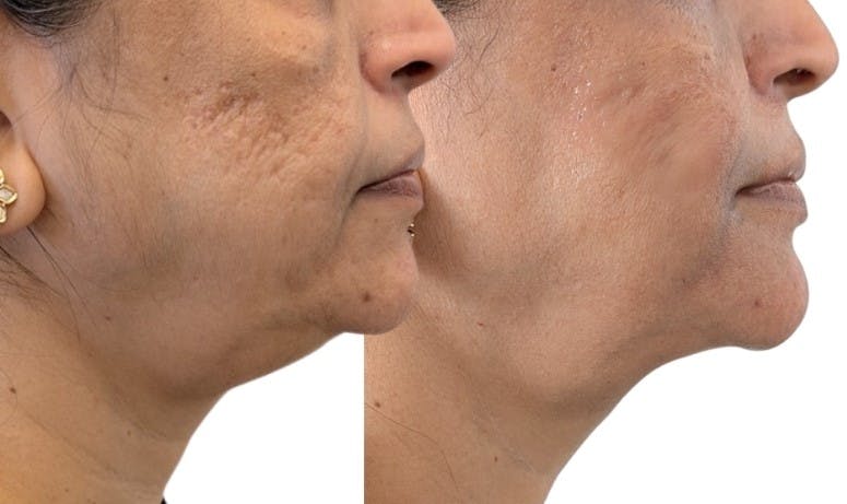 Morpheus8® Before & After Gallery - Patient 213952 - Image 1