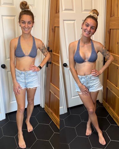 Patient Selfies Before & After Gallery - Patient 279143 - Image 1