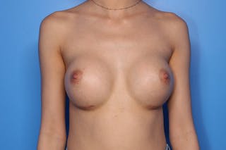 Breast Augmentation Before & After Gallery - Patient 398261 - Image 2