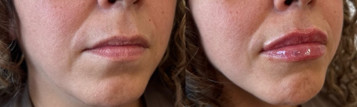 Lip Filler Before & After Gallery - Patient 154515 - Image 1