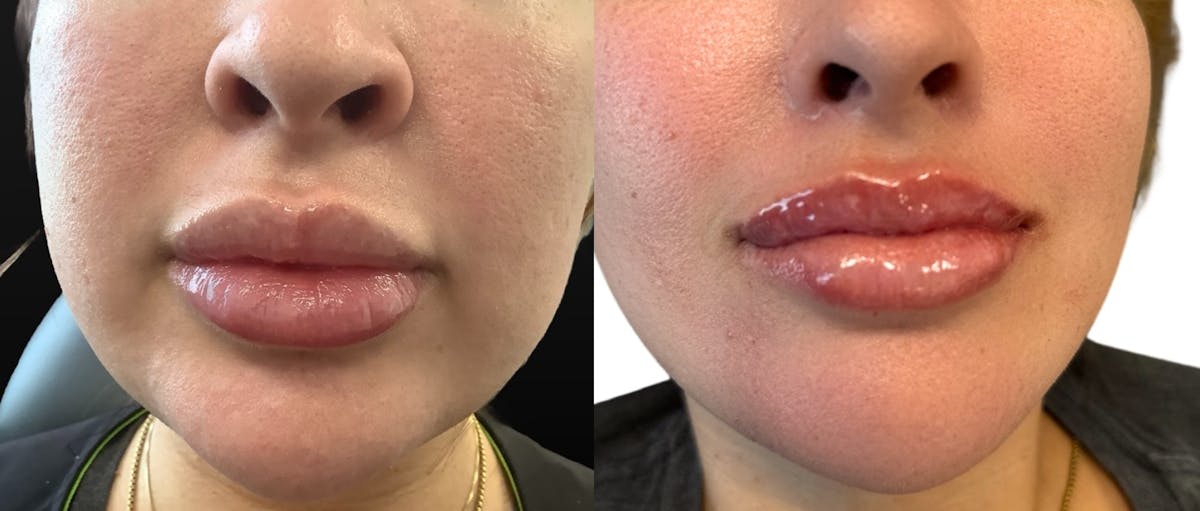 Juvéderm® Before & After Gallery - Patient 146637 - Image 1