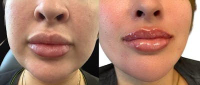 Lip Filler Before & After Gallery - Patient 408834 - Image 1