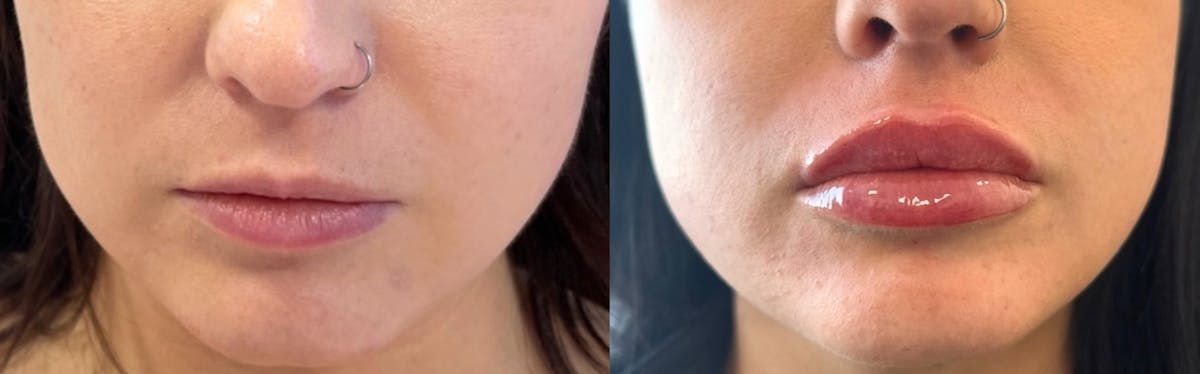 Lip Filler Before & After Gallery - Patient 144134 - Image 1