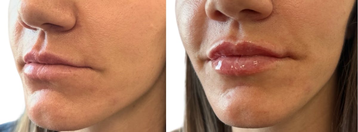 Lip Filler Before & After Gallery - Patient 428300 - Image 2