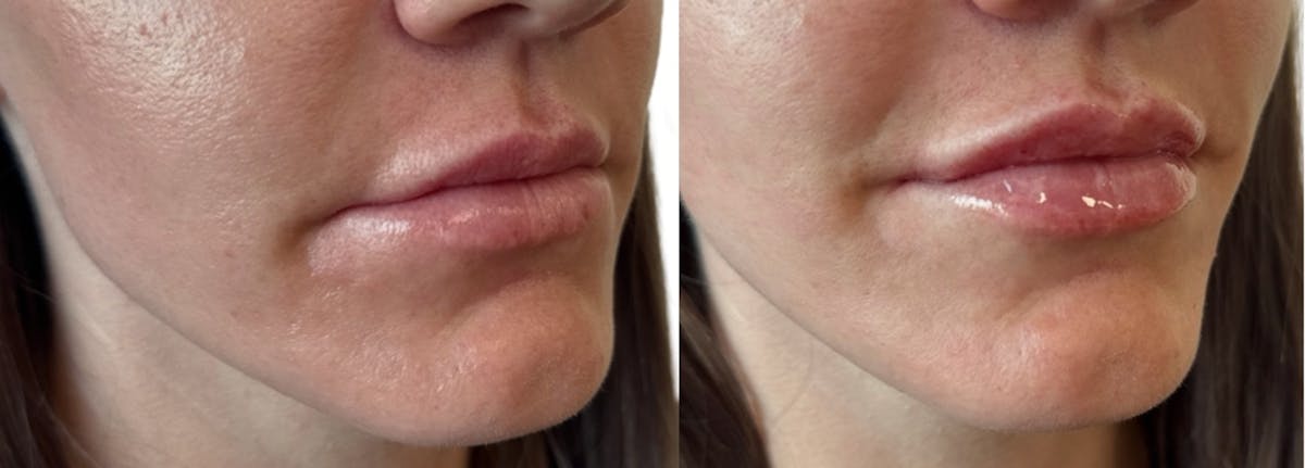 Lip Filler Before & After Gallery - Patient 428300 - Image 1