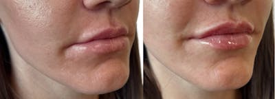 Lip Filler Before & After Gallery - Patient 428300 - Image 1