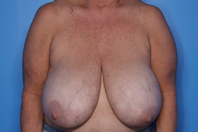 Breast Reduction Before & After Gallery - Patient 311598 - Image 1
