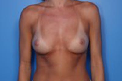 Breast Augmentation Before & After Gallery - Patient 212618 - Image 1