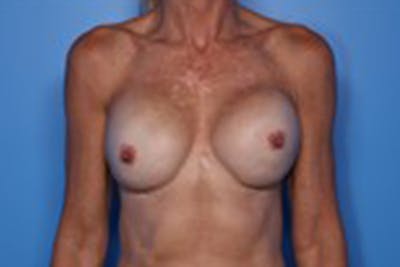 Implant Exchange Before & After Gallery - Patient 413756 - Image 1
