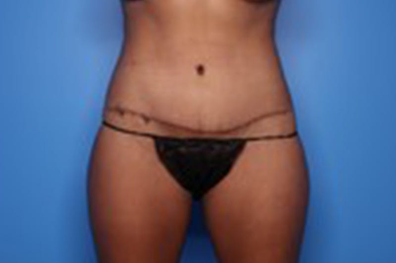 Body Lift Before & After Gallery - Patient 218647 - Image 2
