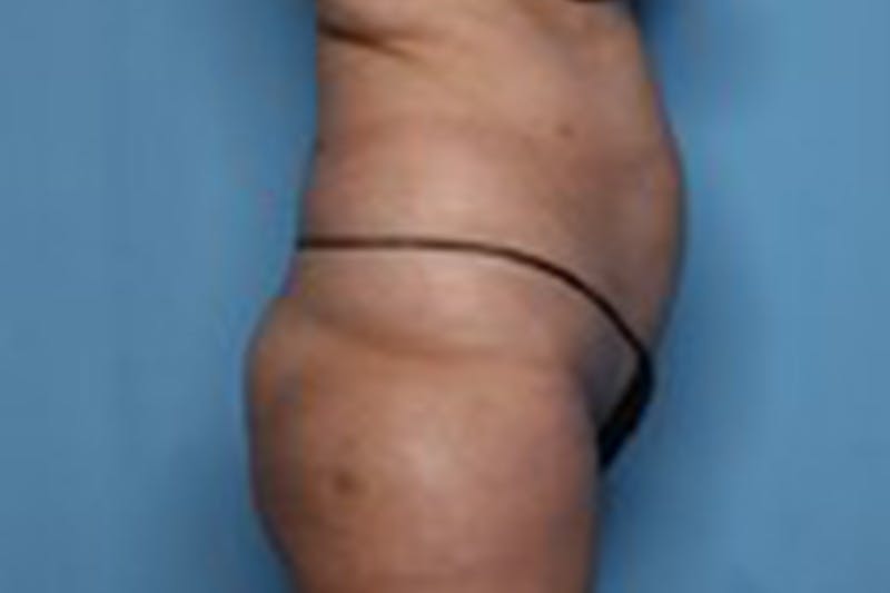 Liposuction Before & After Gallery - Patient 211307 - Image 5
