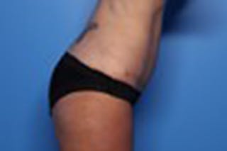 Liposuction Before & After Gallery - Patient 211307 - Image 8