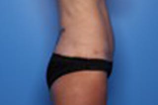 Liposuction Before & After Gallery - Patient 211307 - Image 6