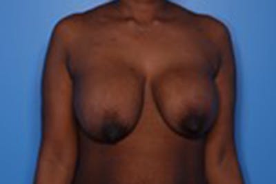 Implant Exchange Before & After Gallery - Patient 260667 - Image 1