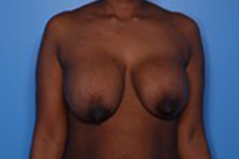 Implant Exchange Before & After Gallery - Patient 260667 - Image 1