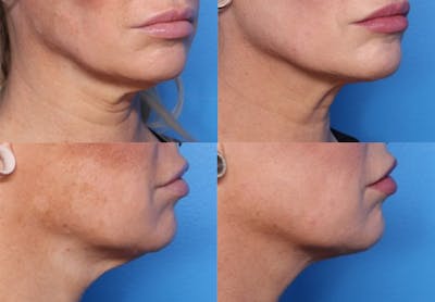 FaceTite Before and After Before & After Gallery - Patient 193876 - Image 1