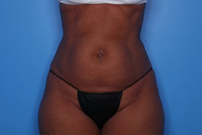 BodyTite™ Before and After Before & After Gallery - Patient 376284 - Image 1