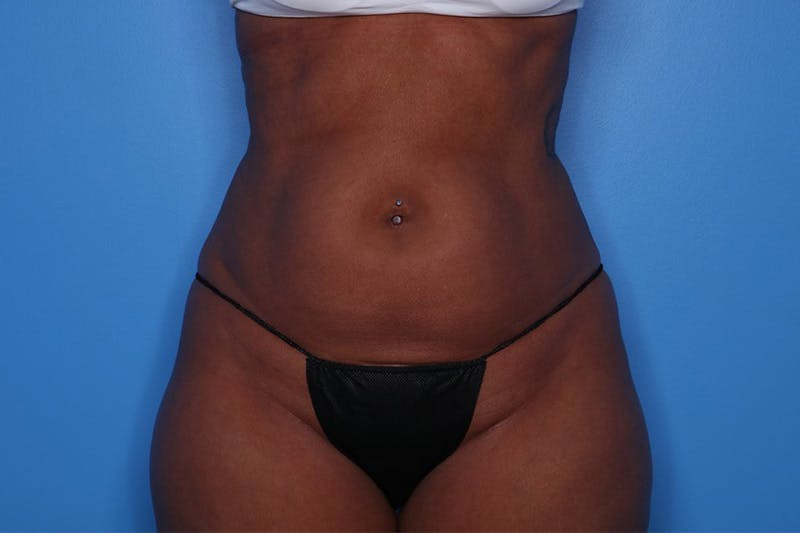 BodyTite™ Before and After Before & After Gallery - Patient 376284 - Image 1