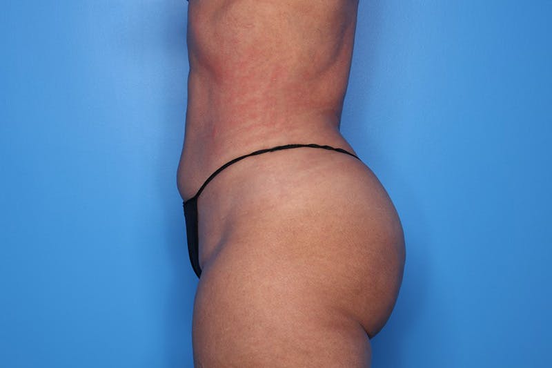 BodyTite™ Before and After Before & After Gallery - Patient 376284 - Image 6