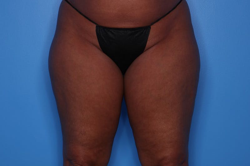 BodyTite™ Before and After Before & After Gallery - Patient 376284 - Image 9