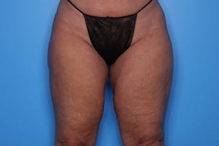 BodyTite™ Before and After Before & After Gallery - Patient 376284 - Image 10