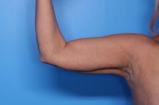 BodyTite™ Before and After Before & After Gallery - Patient 376284 - Image 14