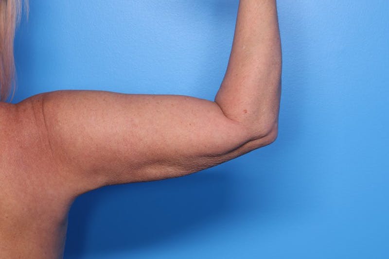 BodyTite™ Before and After Before & After Gallery - Patient 376284 - Image 12