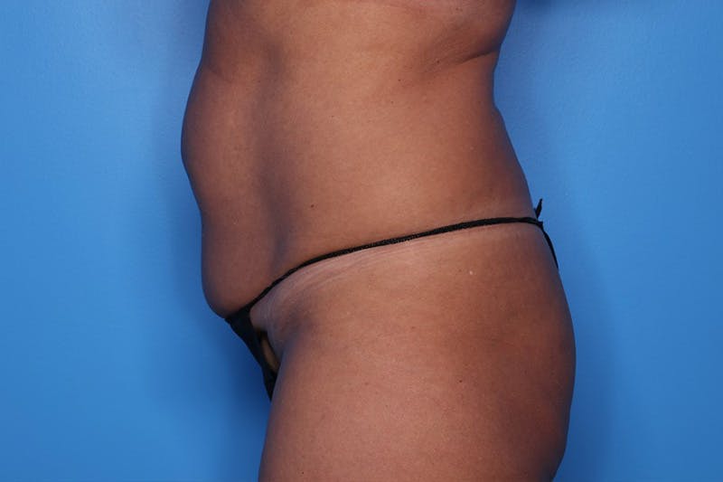 Tummy Tuck Before & After Gallery - Patient 270933 - Image 3
